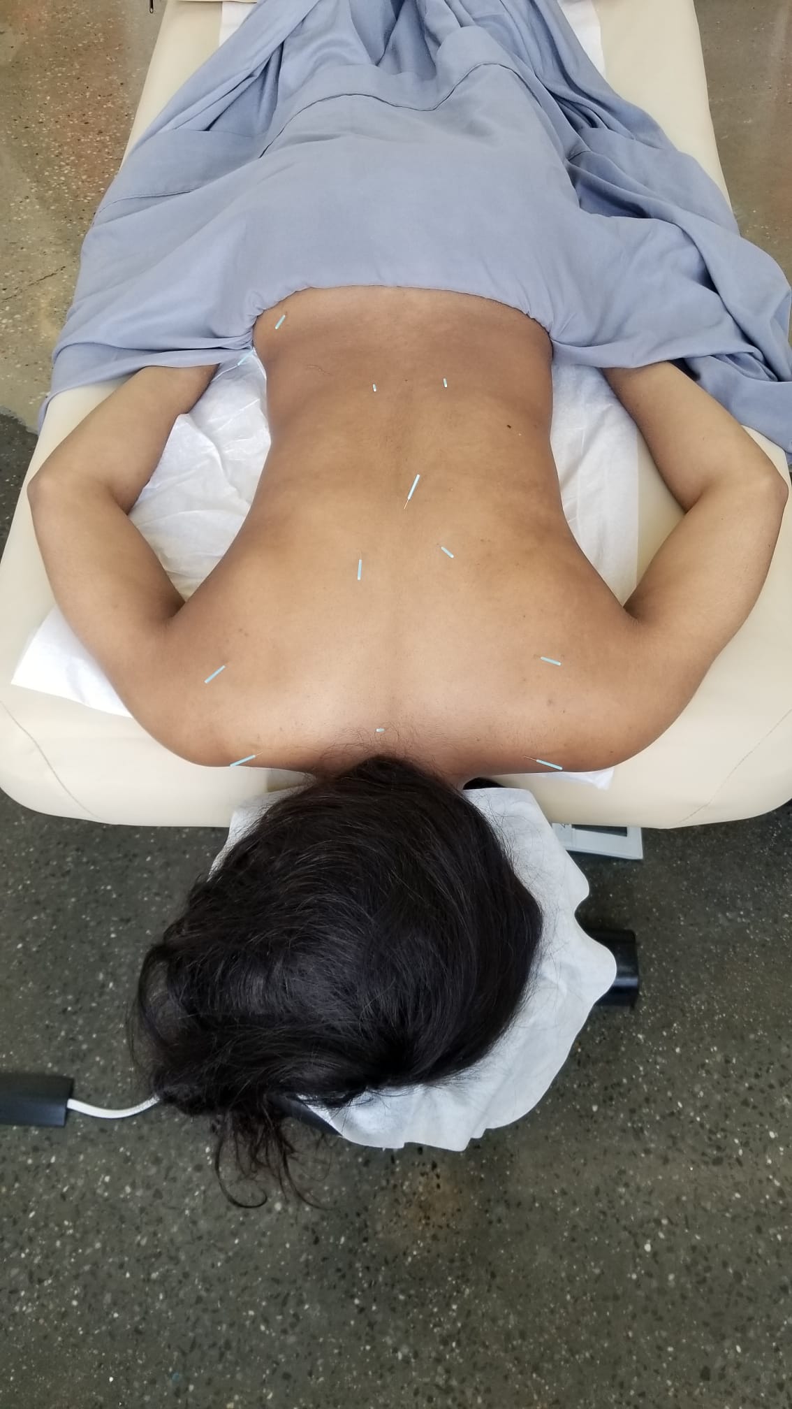 A person receiving acupuncture treatment